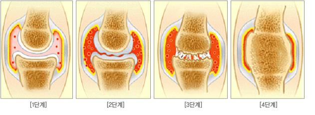 퇴행성 관절 질환의 진행 병기