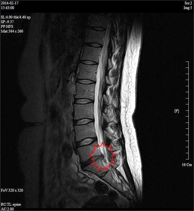 요추 디스크 탈출증 MRI 1 sagittal view
