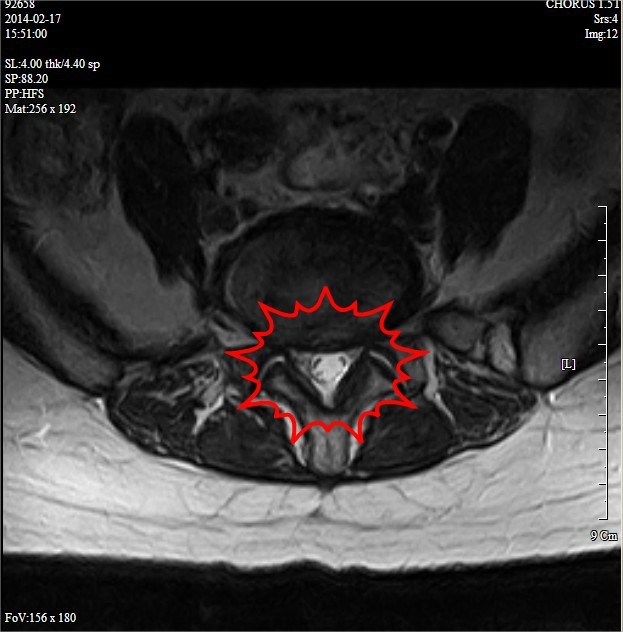 요추디스크탈출증 환자의 transverse view MRI