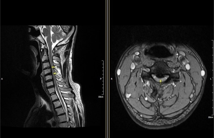 후종인대골화증 환자의 MRI 사진 3~4