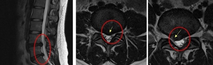 만18세 허리 디스크와 협착증 MRI 사진