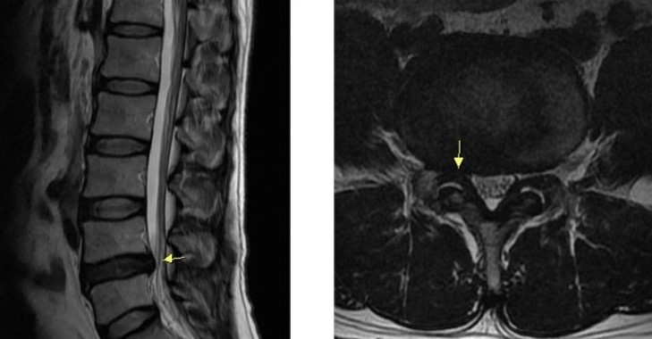 먼49세 허리 디스크와 협착증 MRI 사진