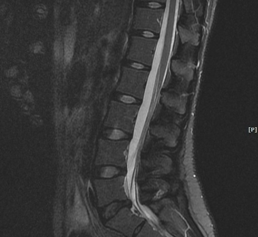 허리 MRI sagittal 화면