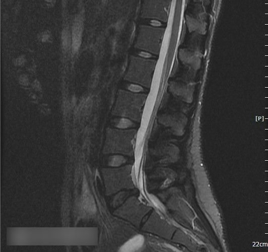 허리 MRI sagittal view