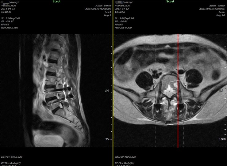 척추감압술 MRI-2