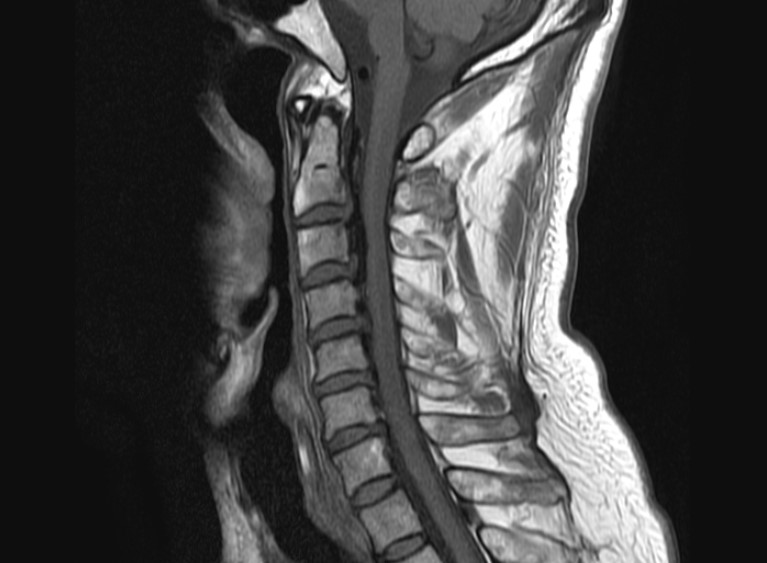 후종인대골화증 이미지 4 MRI