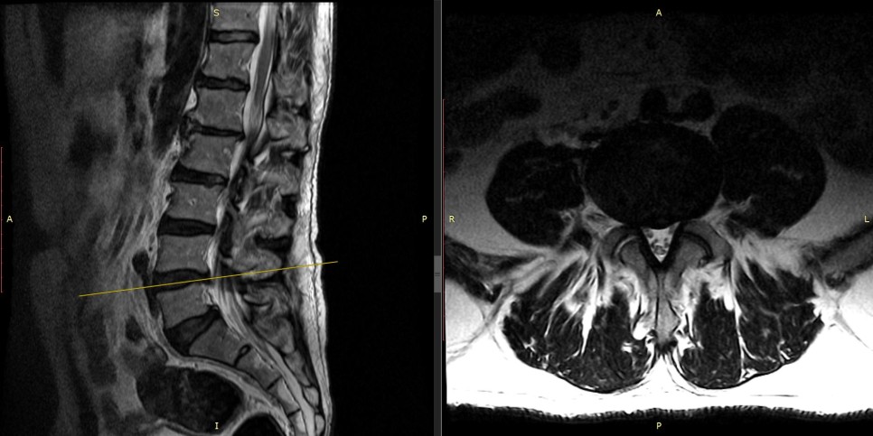 다발성 허리 디스크 및 협착증 MRI