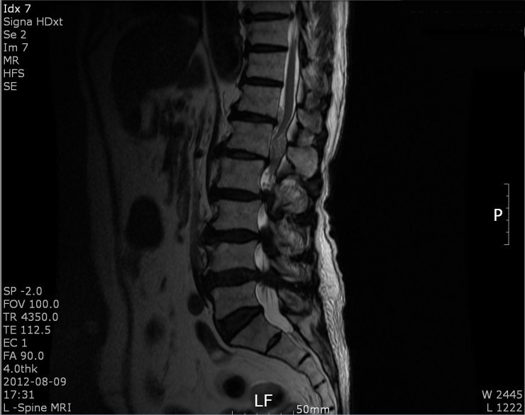 요추관협착증 MRI 사진