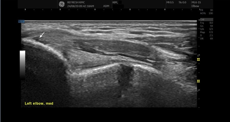 내측 팔꿈치 초음파 장면, 골프엘보