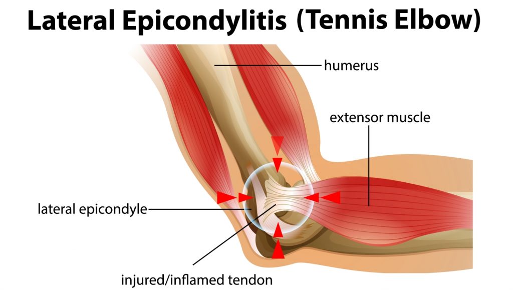 테니스엘보, 외측상과염, lateral epicondilitis  도해